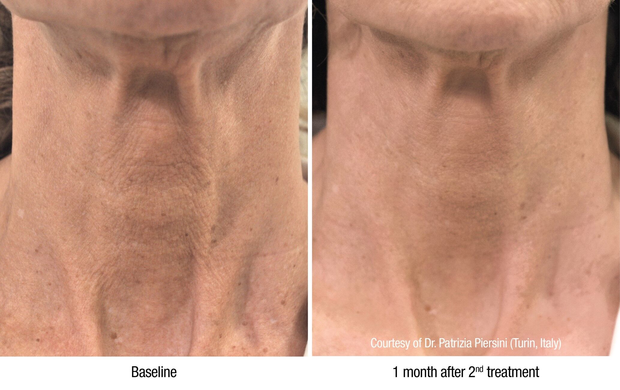 Introduction of Profhilo, the latest in skin hydration